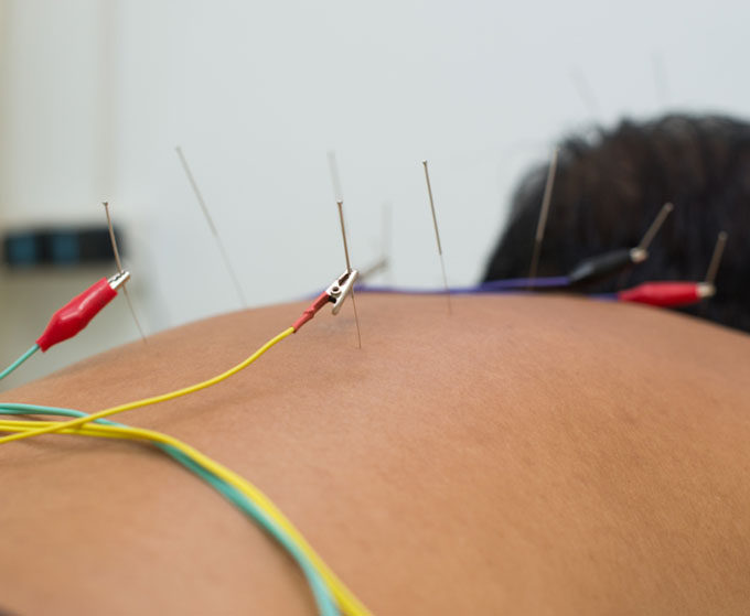 Electroacupuncture Treatment in Marietta & Atlanta GA Acupuncture