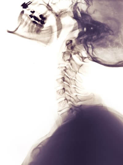 cervical spine xray side view